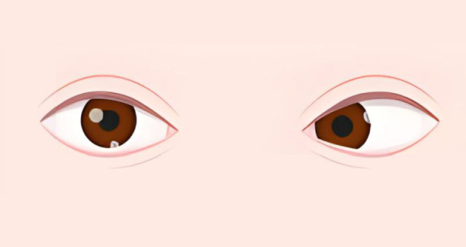 Esotropia