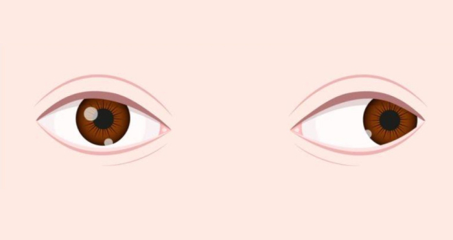 Exotropia