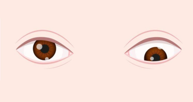 Hypotropia