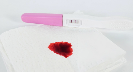 Image representing Is It Normal to Have Blood Spotting During Pregnancy? What’s Normal and When to Visit Us